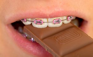 Chocolate with Braces