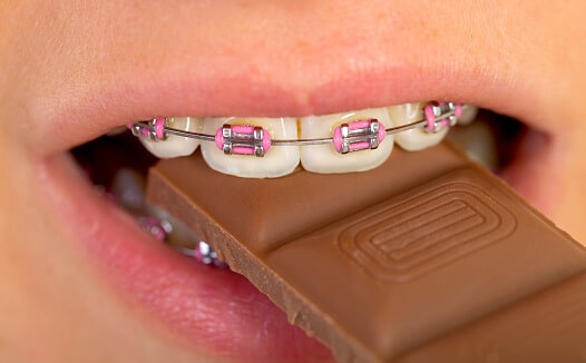 what color braces to avoid