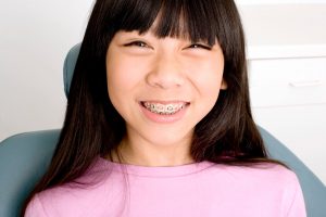Braces with Crowns