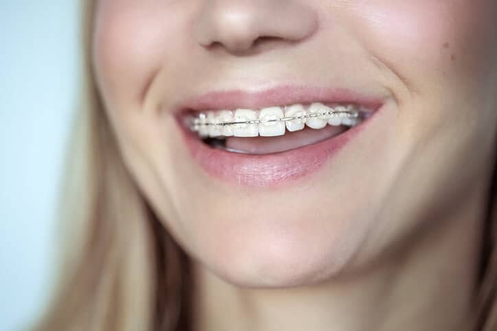 Braces, treatment for a crooked teeth