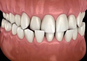 Anterior crossbite dental occlusion ( Malocclusion of teeth ). Medically accurate tooth 3D illustration | King Orthodontics