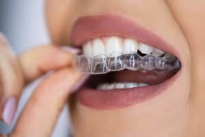 Clear Aligner Dental Night Guard | King Orthodontics