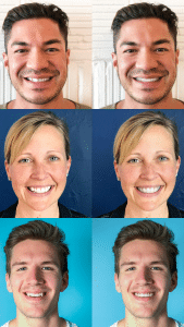 King Orthodontics Before and After